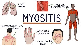 Understanding Myositis Polymyositis and Dermatomyositis [upl. by Ecirtemed110]