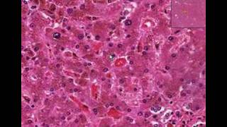 Histopathology LiverHemochromatosis [upl. by Ratna]