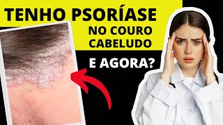 PSORÍASE NA CABEÇA COMO TRATAR SAIBA [upl. by Garibald]