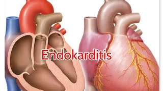 Endokarditis entzündliche Herzerkrankungen [upl. by Milzie353]