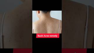 quotBanishing Back Acne The Ultimate Guide to Clear Skinquotಬೆನ್ನಿನ ಮೊಡವೆ ಚರ್ಮವನ್ನು ತೆರವುಗೊಳಿಸಲು [upl. by Heida]