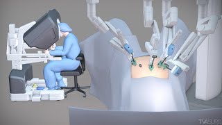 Robotic hysterectomy for high BMI patients  TVASurg [upl. by Nulubez424]