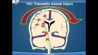 Diffuse Axonal Injury Radiology tutorials 1000 videos in 100 days video 39 [upl. by Naeroled]