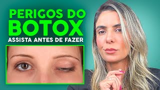 Ptose De Pálpebra por botox [upl. by Enert]