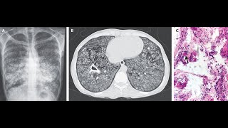 Pulmonale alveoläre Microlithiasis kompliziert durch Tuberkulose [upl. by Iaoh]