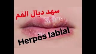 Épisode 54  Herpès labial سهد ديال الفم مع الدكتور معاد [upl. by Andromada787]