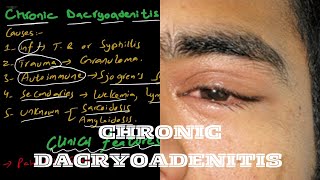 Chronic Dacryoadenitis  lacrimal system [upl. by Streeter]