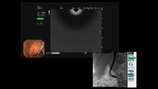 EUS guided Biliary Drainage Rendezvous [upl. by Aisac209]