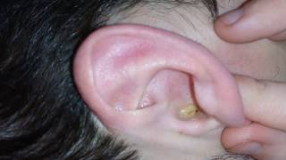 Melting earwax with Otex [upl. by Oric821]