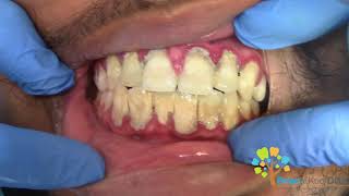 Dental Cleaning to remove heavy tartar🦷 【Young Male first cleaning】 [upl. by Orofselet877]