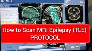 Brain Epilepsy MRI scan Protocol Positioning amp Planning [upl. by Arikal507]