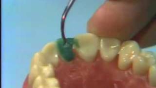 Dental Anatomy Waxing a Maxillary Central Incisor [upl. by Rayburn955]