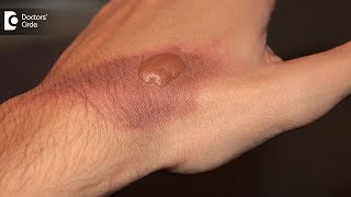 How to treat a burn blister at home Tips to avoid burn scar  Dr Pavan Murdeshwar [upl. by Airdnaed469]