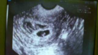 second ultrasound 6wks 3days bleeding Subchorionic hemorrhage [upl. by Ayar]