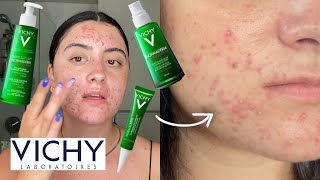 Acne Prone Skin Routine Review with VICHY Normaderm [upl. by Maddy224]