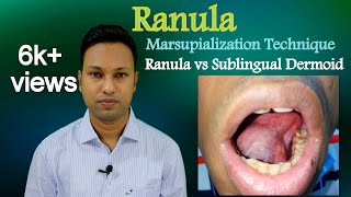 Ranula। How to Marsupialize। Ranula vs Sublingual Dermoid [upl. by Wohlert687]