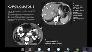 Neoplasias Peritoneales [upl. by Monteria]