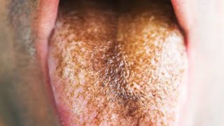 What is Hairy Tongue Causes Symptoms and Treatment [upl. by Isla]