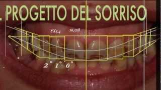 Cambiare laspetto del sorriso con faccette dentali  SMILE DESIGN [upl. by Nosrej]