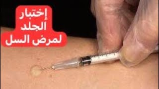 إختبار الجلد لمرض السل Tuberculin Skin Test [upl. by Pier41]