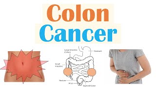 Colon Cancer CRC Risk Factors Pathogenesis Symptoms Diagnosis Staging Treatment [upl. by Repmek109]