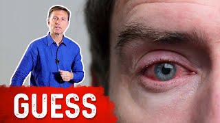 What Causes Bloodshot Eyes – DrBerg [upl. by Ann939]