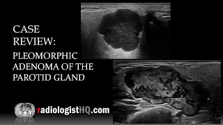 Ultrasound of Pleomorphic Adenoma of the Parotid Gland [upl. by Nette582]