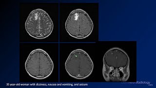 Intracranial infections  5  Other [upl. by Joanne]