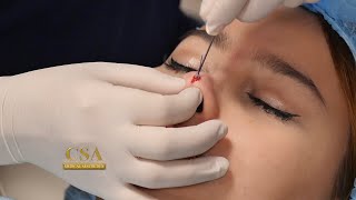 The semipermanent effect of nose threadlift [upl. by Ikuy]