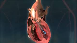 Impella CP® Heart Pump Animation [upl. by Maisey884]