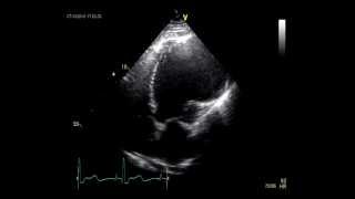 LEFT VENTRICULAR ANEURYSM  ECHOCARDIOGRAPHY [upl. by Nylodam]