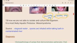 rhinosporidiosis microbiology ENT [upl. by Eirrehc877]