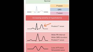 Hyperkalemia  MBBS LECTURES  neetpg ecg mbbs [upl. by Ayotnahs]