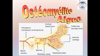 Ostéomyélite aiguë hematogene [upl. by Elaval80]