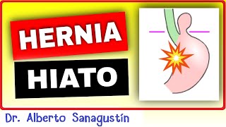 HERNIA DE HIATO 💥 Causas Síntomas Clasificación y Tratamiento [upl. by Sevy35]