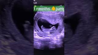 Level 2 ultrasound गर्भवती का महत्वपूर्ण अल्ट्रासाउंड [upl. by Sirred]