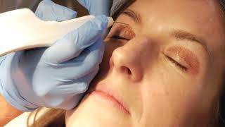 Non surgical blepharoplasty with PLEXR [upl. by Onil]