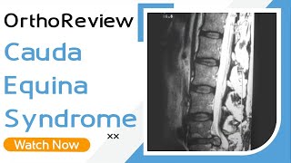 OrthoReview  Cauda Equina Syndrome [upl. by Warrick115]