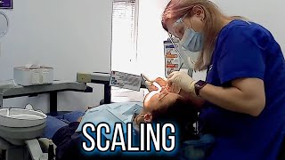 Removal dental tartar  scaling by dental hygienist [upl. by Durno]