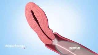 Sperm Retrieval Techniques [upl. by Latsyrhk]