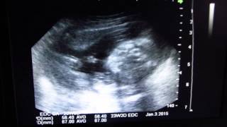 Ultrasound at 21 weeks gender reveal [upl. by Eiramanit]