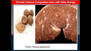 Bilharziasis UB Chronic venous congestion liver fatty change  Chronic rheumatic valvulitis [upl. by Eiddam]