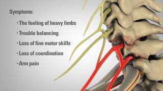 Cervical Laminectomy  Patient Animation [upl. by Odnumde815]