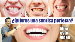 Cómo lograr una DENTADURA PERFECTA 💋 Tienes dientes CHUECOS AMARILLOS y ROTOS 🤩 SANTIAGO BURGA 3D [upl. by Feldman376]