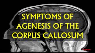 SYMPTOMS OF AGENESIS OF THE CORPUS CALLOSUM [upl. by Seiden894]