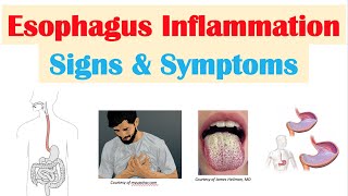 Esophagitis Esophagus Inflammation Signs amp Symptoms amp Why They Occur [upl. by Alym]