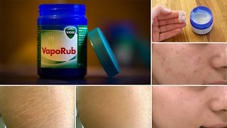 8 Surprising Uses of Vicks Vaporub [upl. by Yellah624]