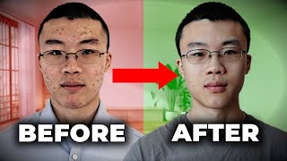 How I Cleared My 7 Year Old Acne  What FINALLY Worked [upl. by William194]