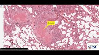 Lung miliary TB microscopy  Talking slide [upl. by Idona716]