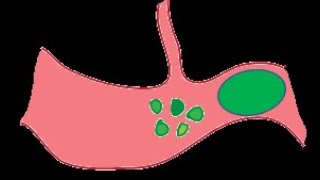 AFE Amniotic Fluid Embolism amp PTE Pulmonary Thromboembolism in Pregnancy [upl. by Ennazzus434]